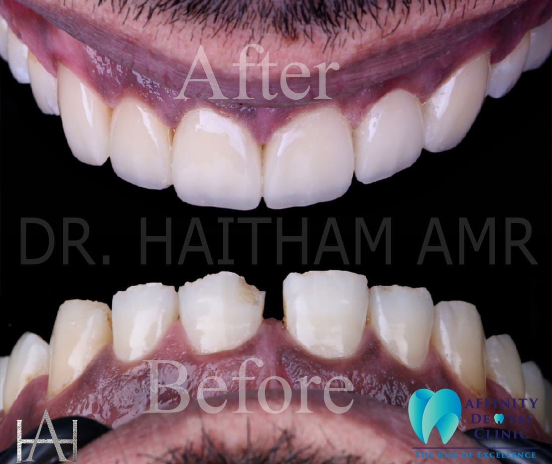 Before and After